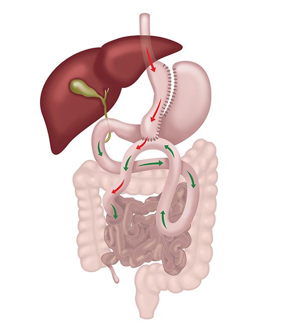 One anastomosis gastric bypass diagram