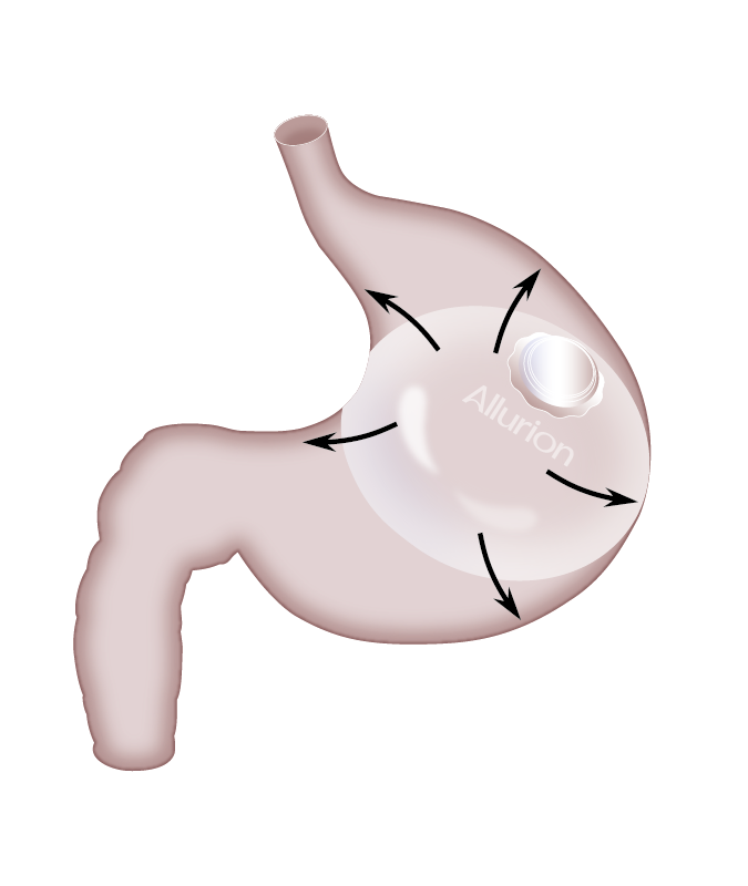 Allurion swallowable intragastric balloon capsule