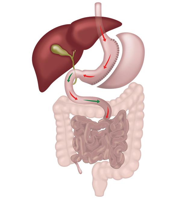 Sleeve gastrectomy
