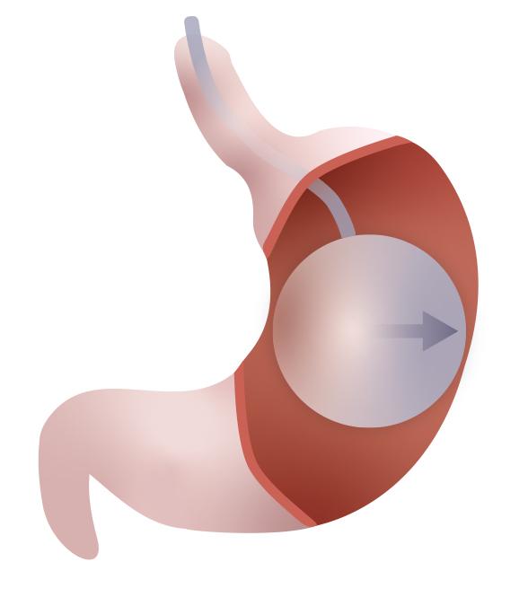 Intragastric balloon