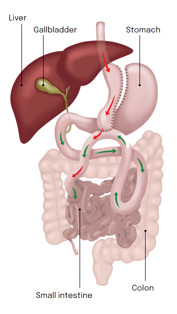 One Anastomosis Gastric Bypass OAGB diagram