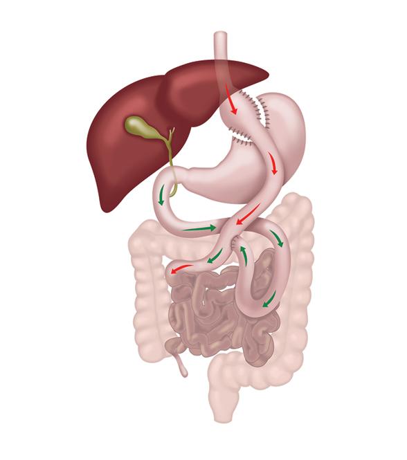 Gastric bypass diagram
