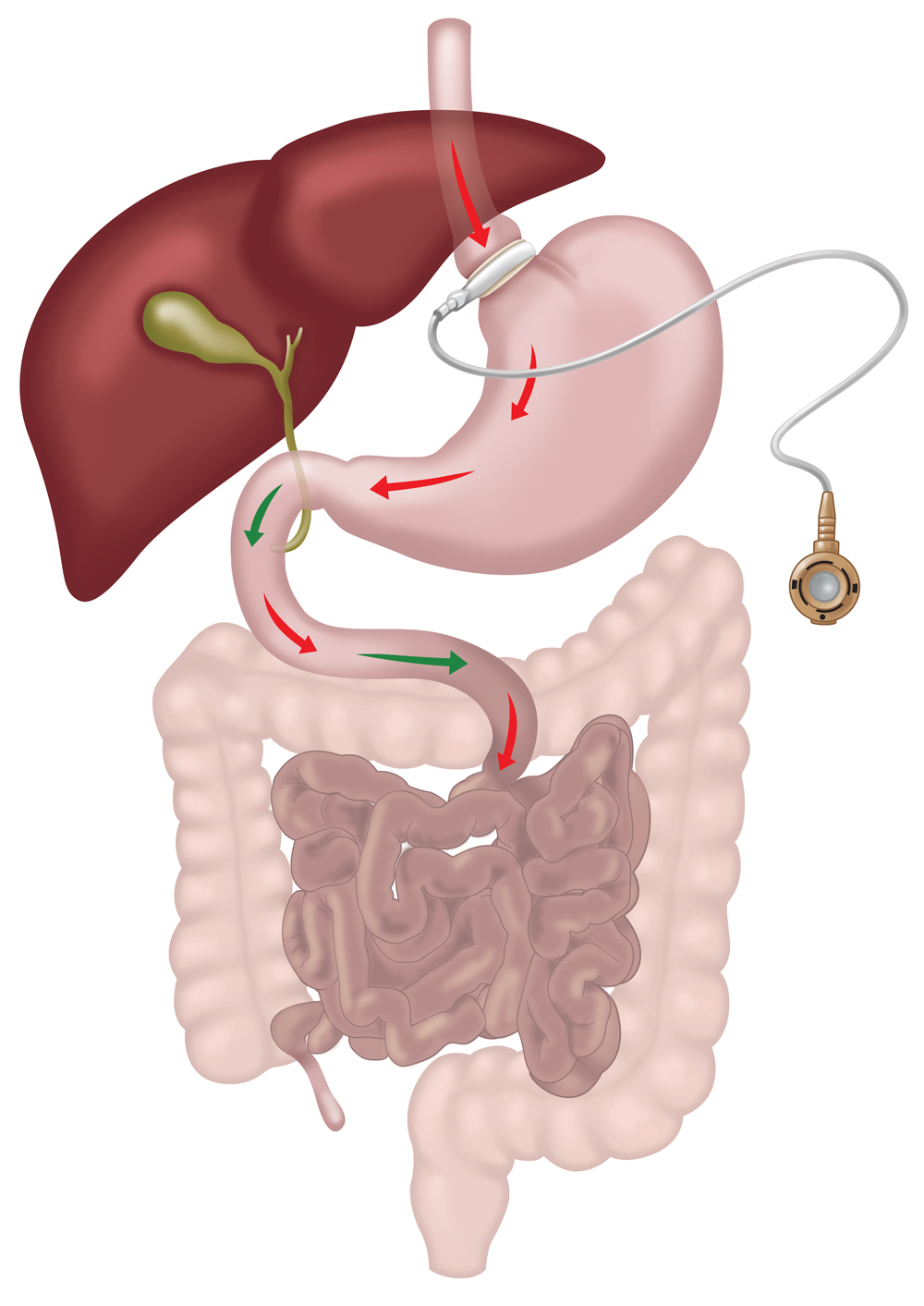 Gastric band laparoscopic surgery diagram