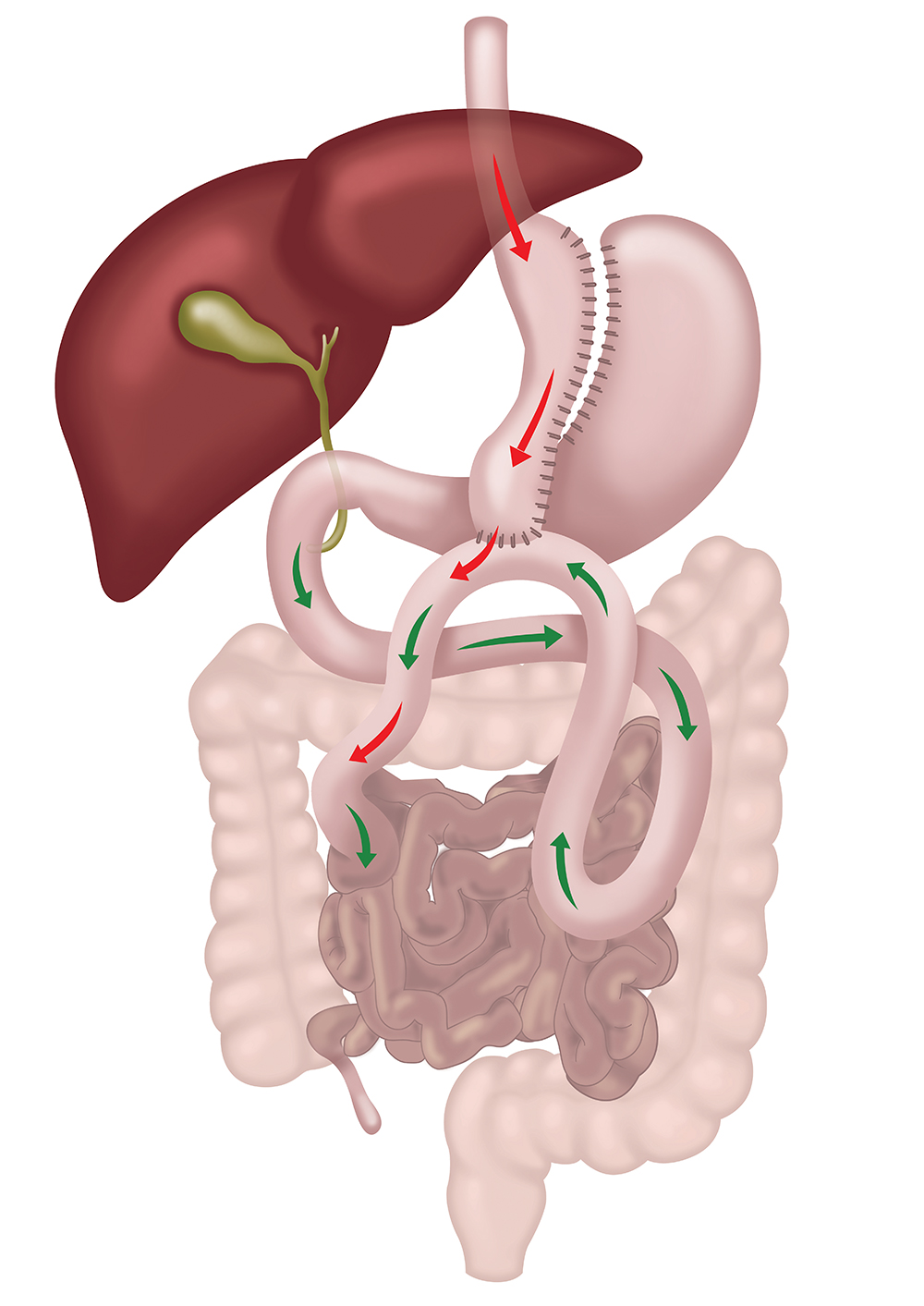 Mini Gastric Bypass surgery diagram