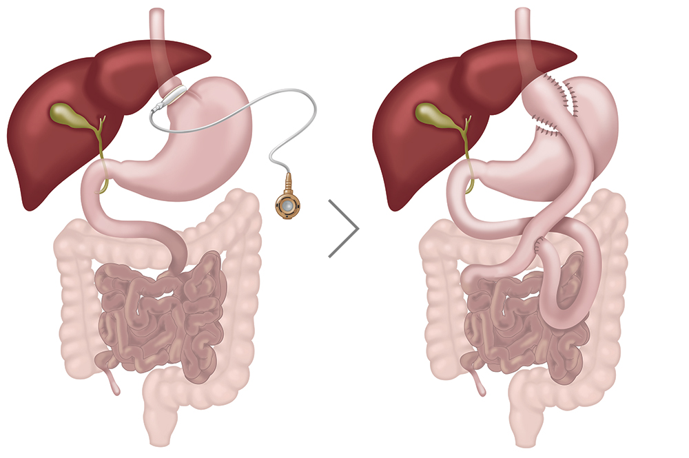 Revisional bariatric surgery illustration