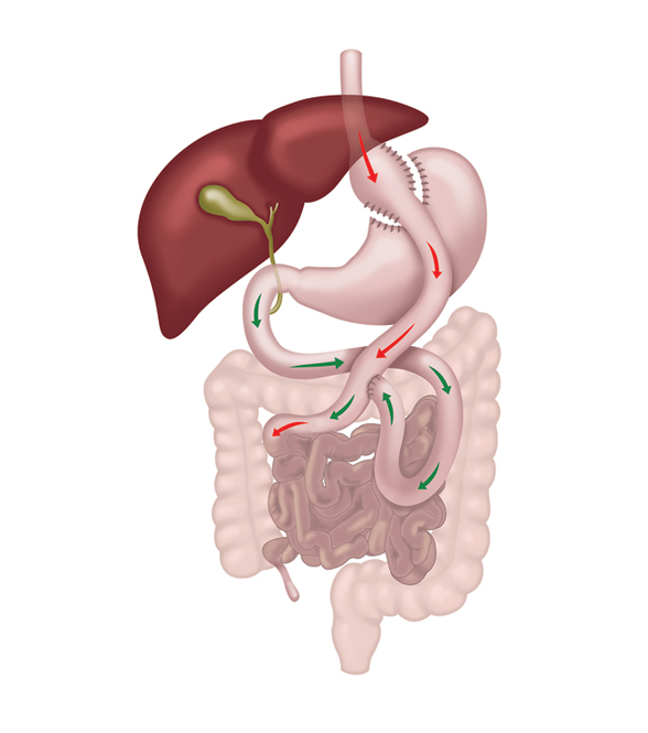 Gastric bypass diagram