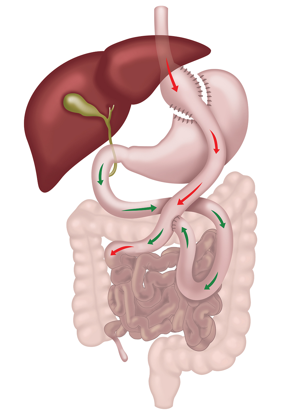 Roux-en-Y Gastric Bypass diagram showing stomach and intestine rerouting