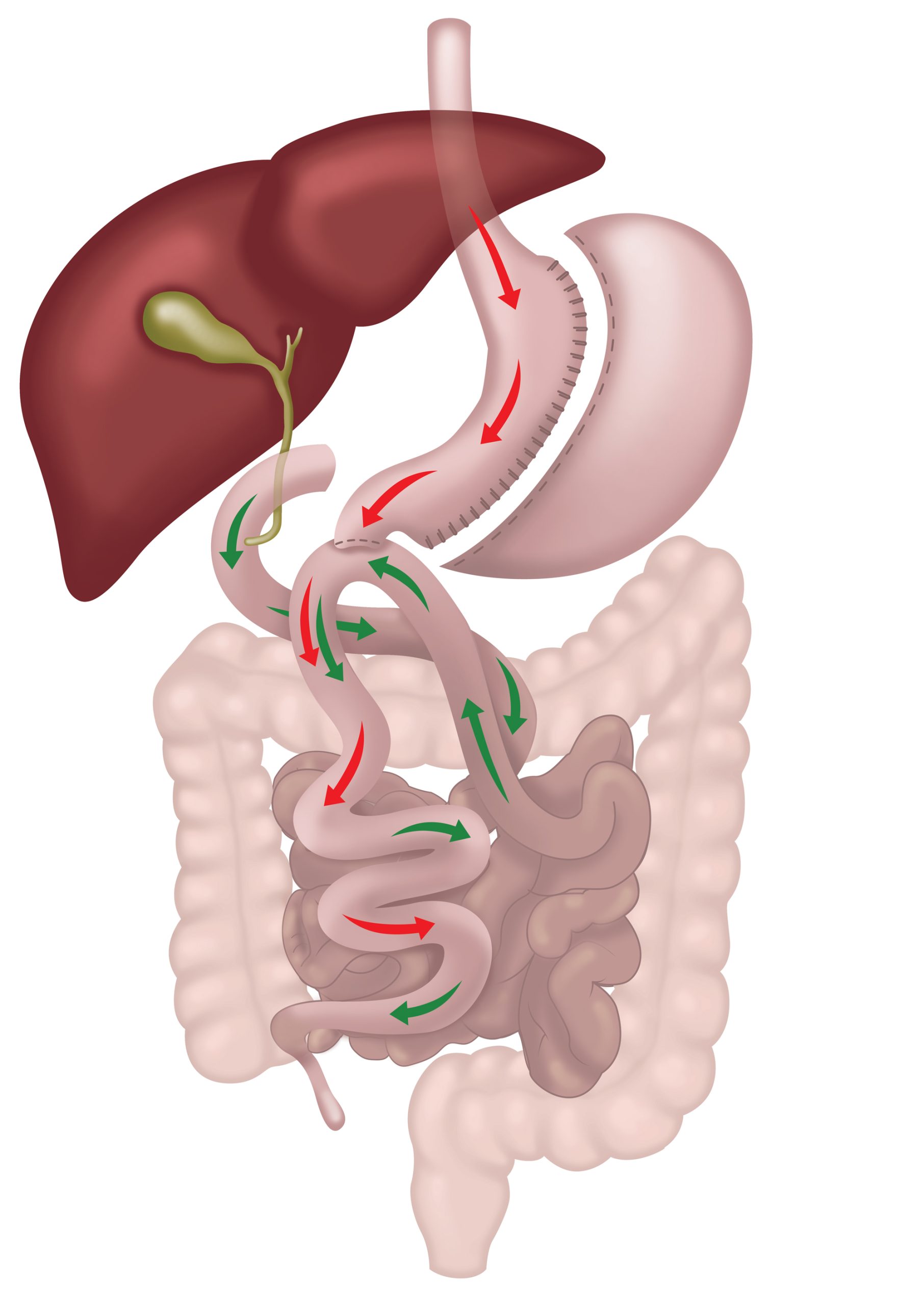 SADI Single Anastomosis Duodeno-Ileal Bypass with sleeve gastrectomy diagram