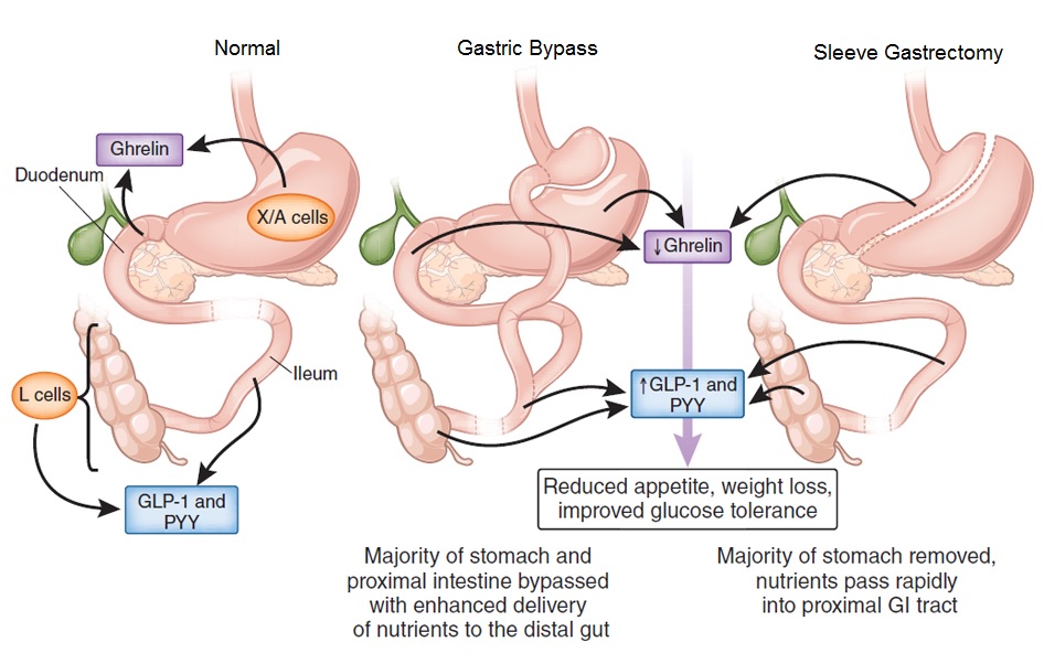 Hunger hormones and weight set point after weight loss surgery